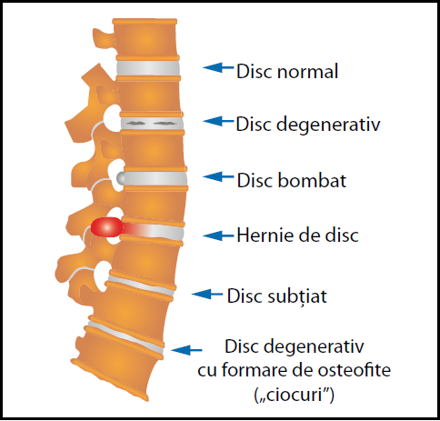 1_ZDS_Hernie_de_disc