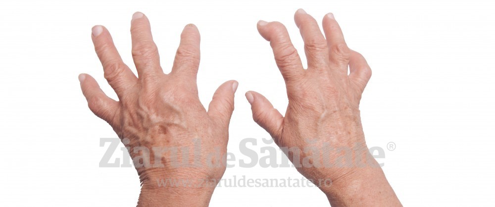 artrita reumatoidă poate fi vindecată definitiv)