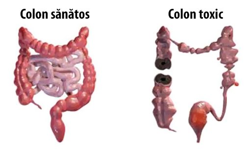 colon-sanatos-vs-colon-toxic