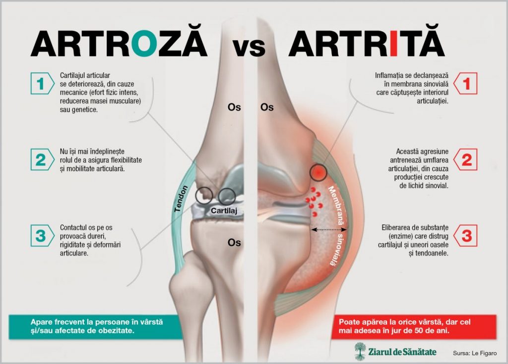 Artroza vs. Artrita : Care este diferența?