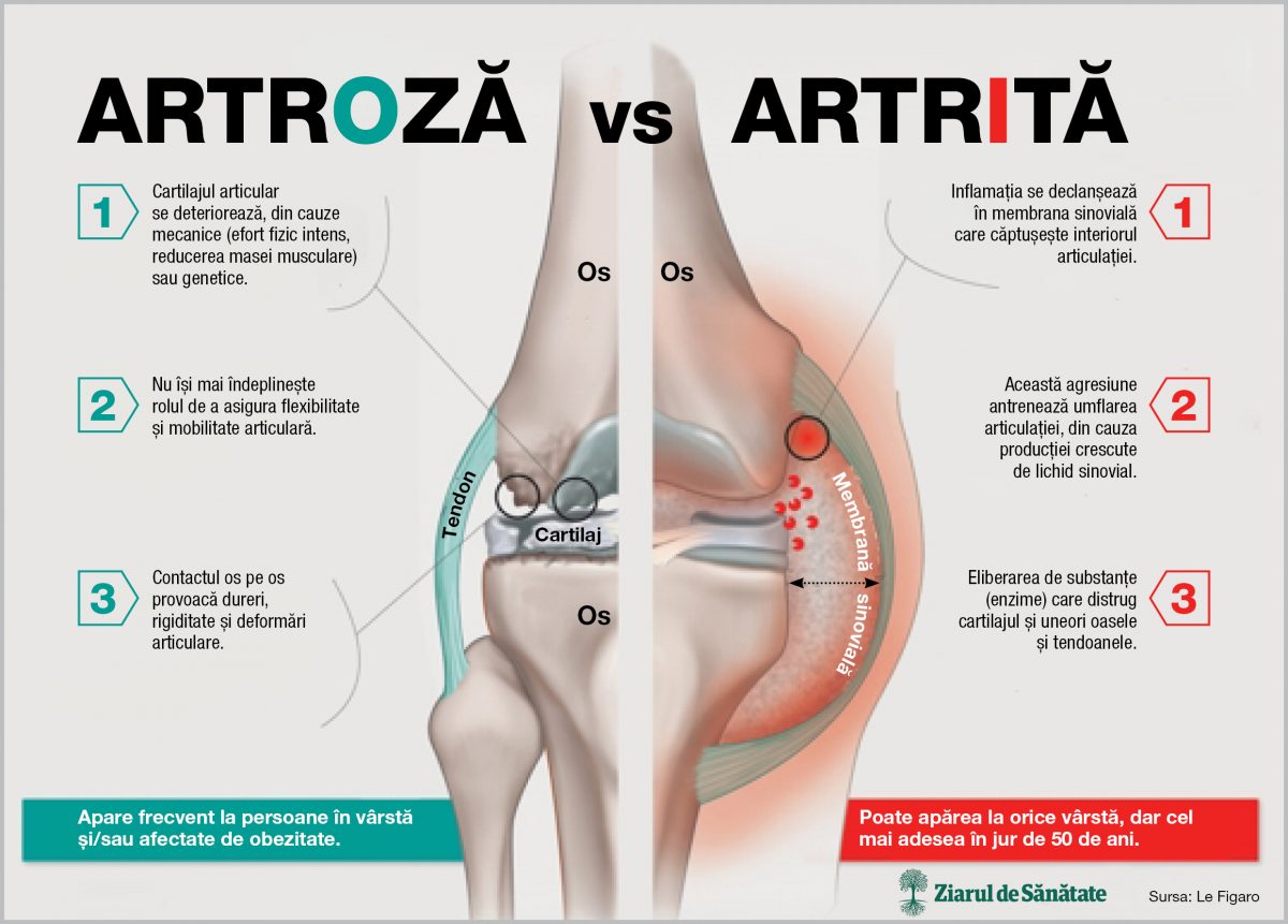 Care sunt diferențele dintre artrita si artroza