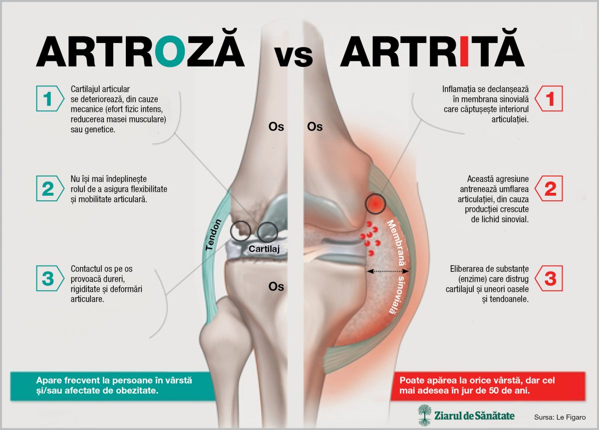 ce sa faci cu artrita artroza articulației umărului și forumul ei de tratament