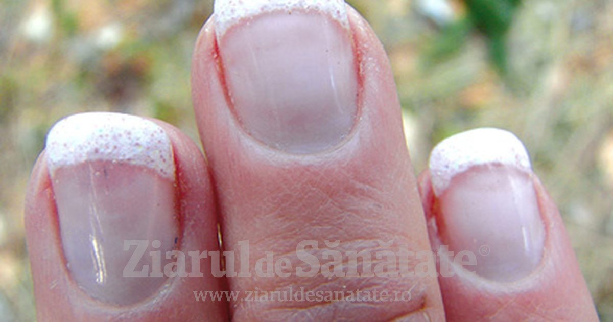 unghiile se exfoliază pe ciuperca mâinilor