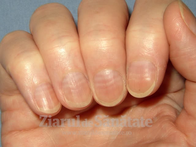 tratamentul ciupercii unghiilor ondulate pe mâini