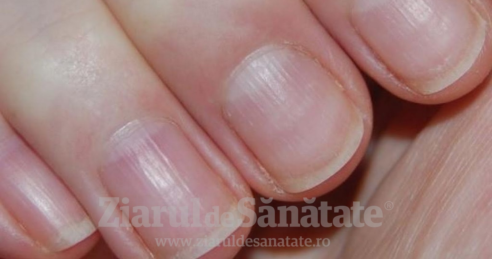 dungi longitudinale pe unghiile mâinilor ciuperca