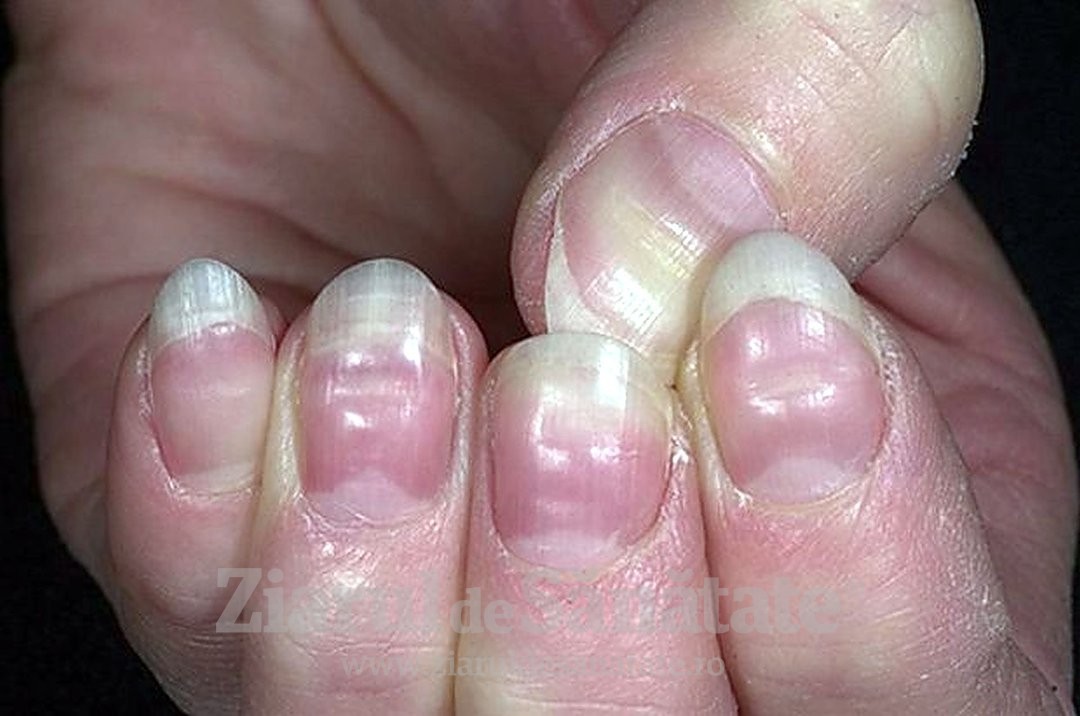 trăiește o problemă sănătoasă despre tratamentul ciupercii unghiilor